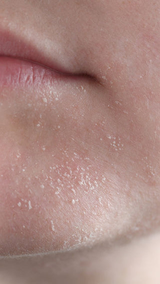 Dehydrated Skin