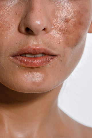 Dull Skin