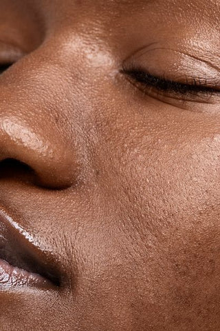 Large Visible Pores
