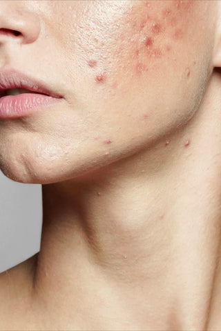 Acne | Kass Skincare Products | Collections