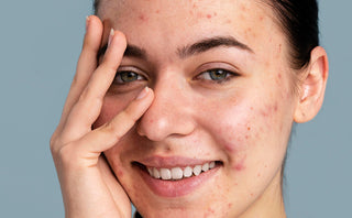 Girl Showing her Acne Breakouts before using Kass Skincare products