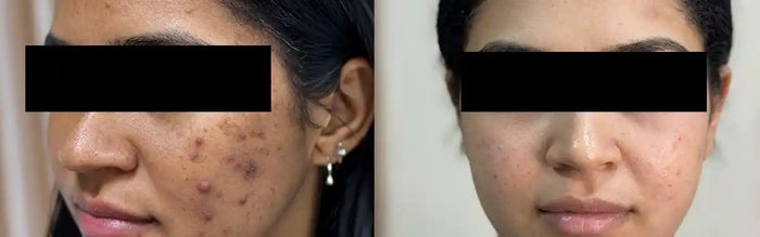 How to Fade Dark Spots Before the Festive Season: A Realistic, Week-by-Week Serum Plan