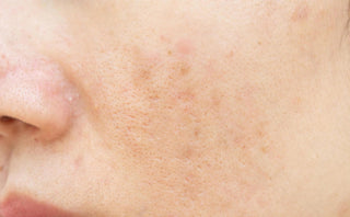 Results After using Gel Based Moisturizer