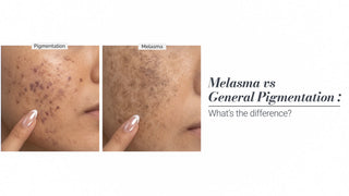 Melasma vs. General Pigmentation: What’s the Difference?