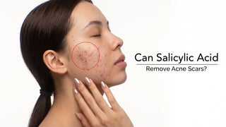 Does Salicylic Acid Remove Acne Scars?