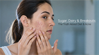 Sugar, Dairy & Breakouts: The Truth About Diet and Acne