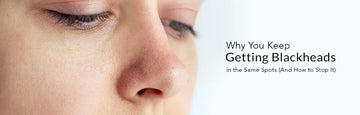 Why You Keep Getting Blackheads in the Same Spots