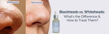 Blackheads vs. Whiteheads