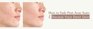 How to Fade Post-Acne Scars