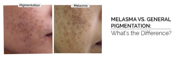 Melasma vs Pigmentation