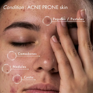 KASS ACNE SOLUTIONS SERUM