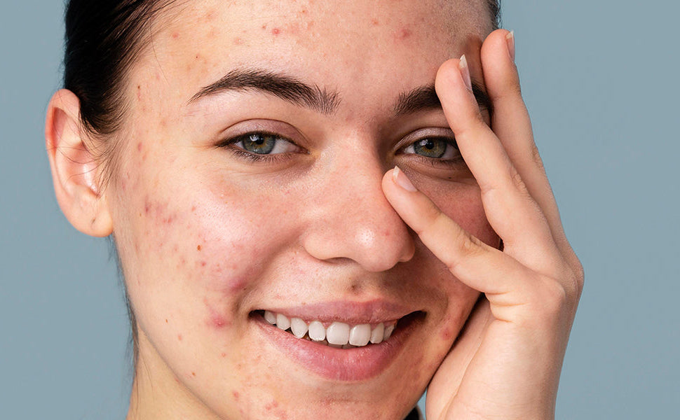 Girl Showing her Acne Breakouts before using Kass Skincare products