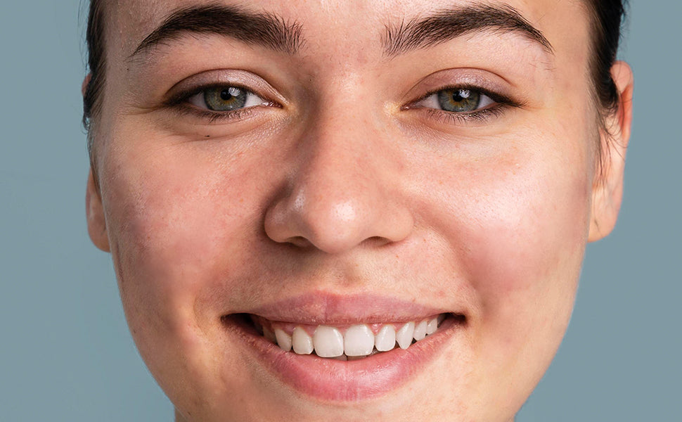 After using Acne Solution of Kass