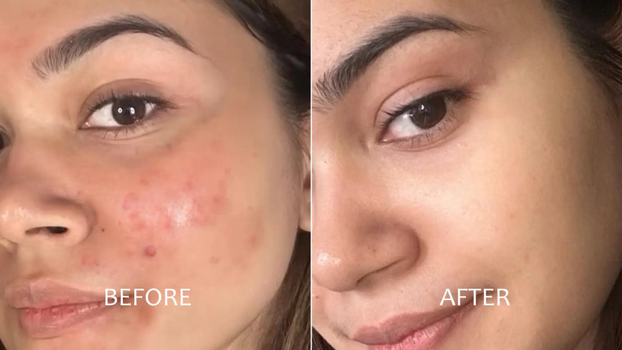 Watch the Acne Cycle Break in 12 Weeks.