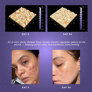 KASS ACNE SOLUTIONS SERUM