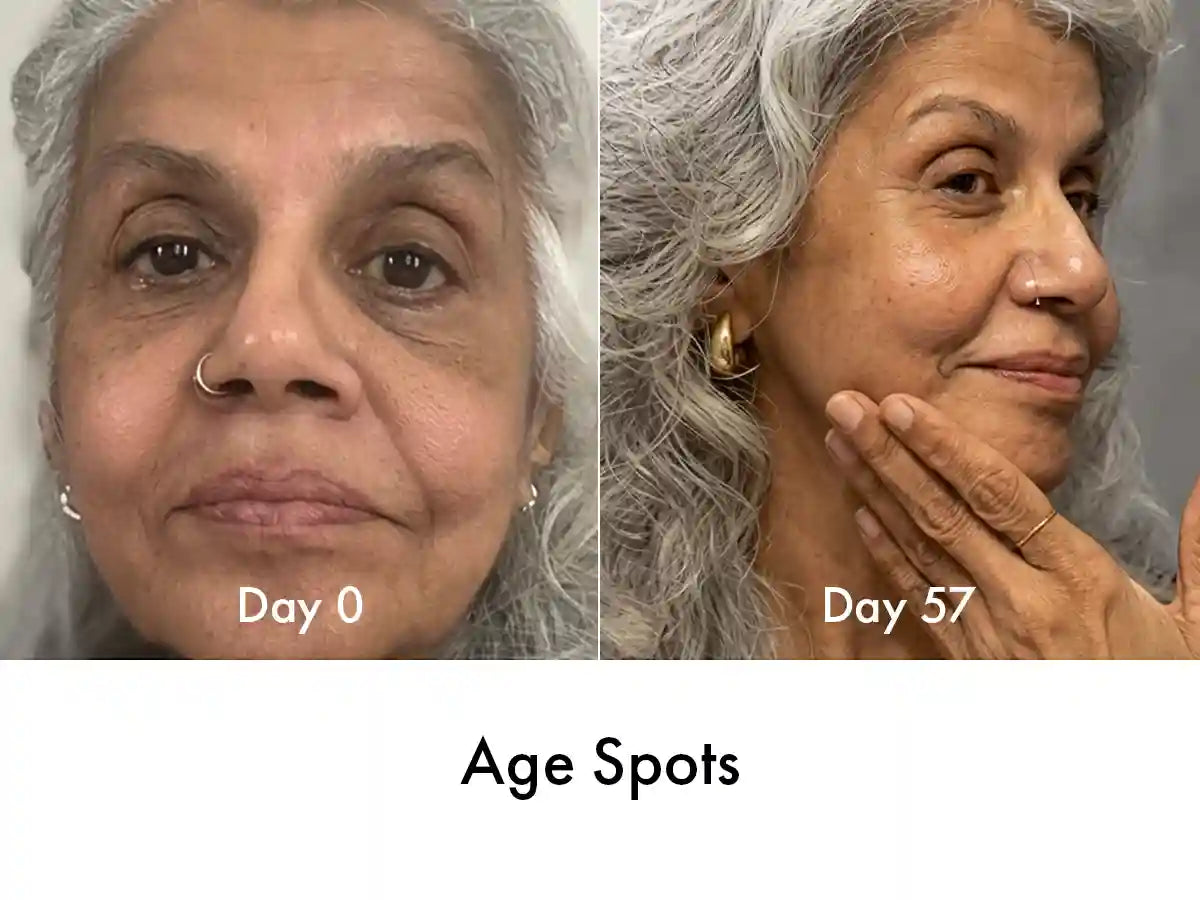 De-pigmentation-Before-and-After-Neck-age-spots
