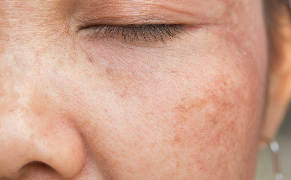 After use of De-Pigmentation serum