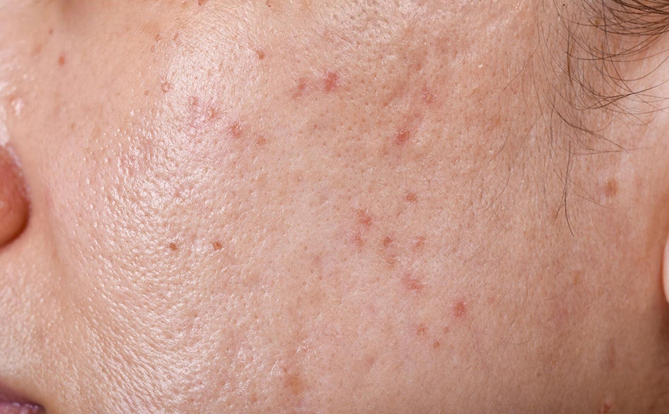 Skin before using Gel Moisturizer