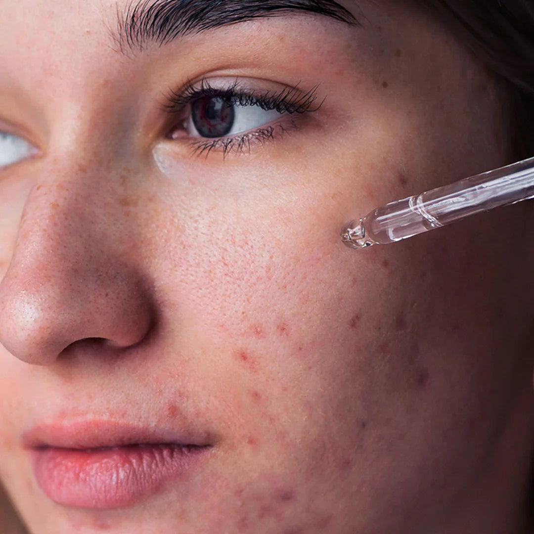 ACNE SOLUTIONS SERUM