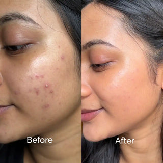 KASS ACNE SOLUTION SERUM