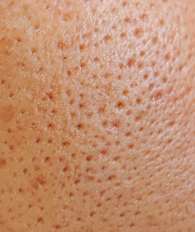 Enlarged Pores