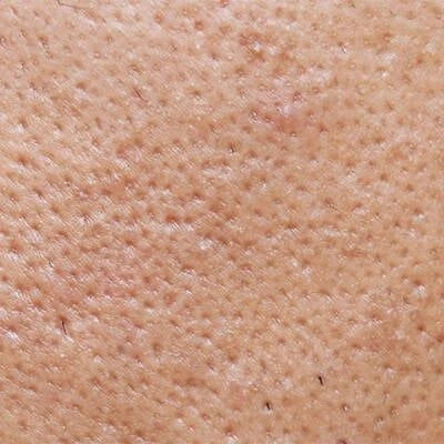 Enlarged Pores